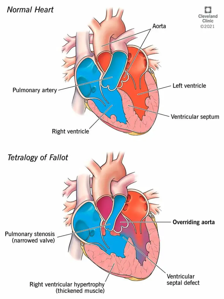 1705076545 23347 overriding aorta