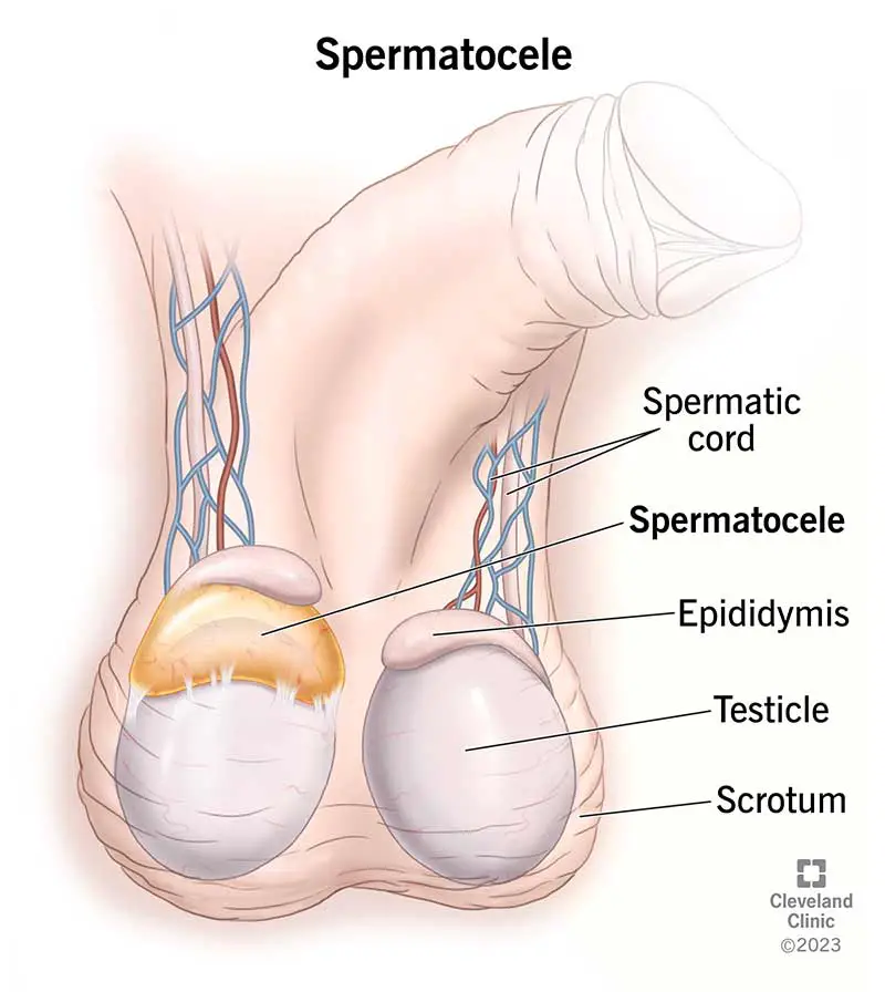 1705118838 17492 spermatocele