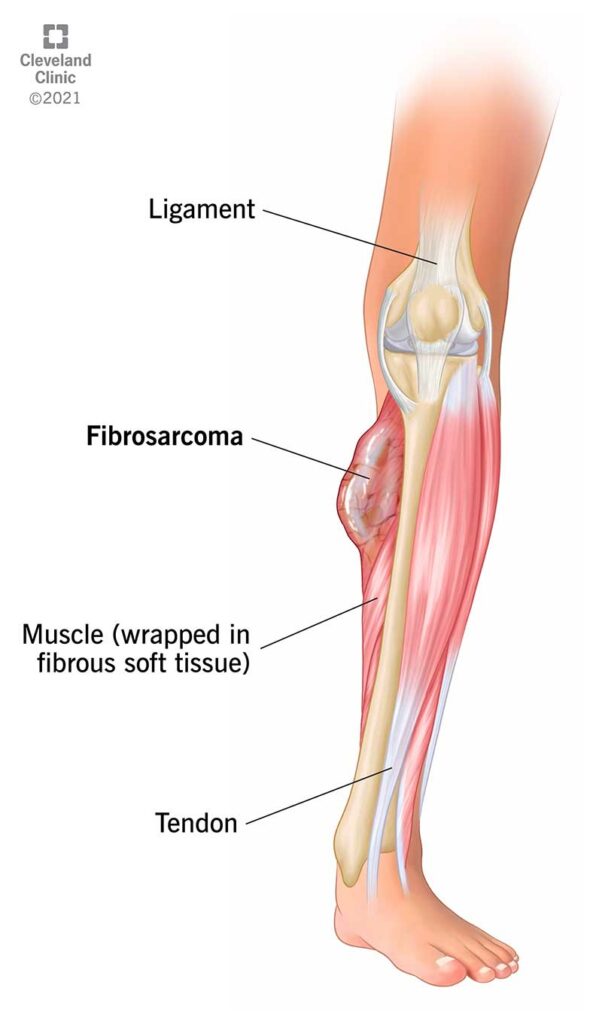 1705134198 22009 fibrosarcoma