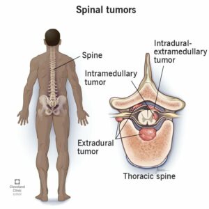 1705195941 17500 spinal tumors