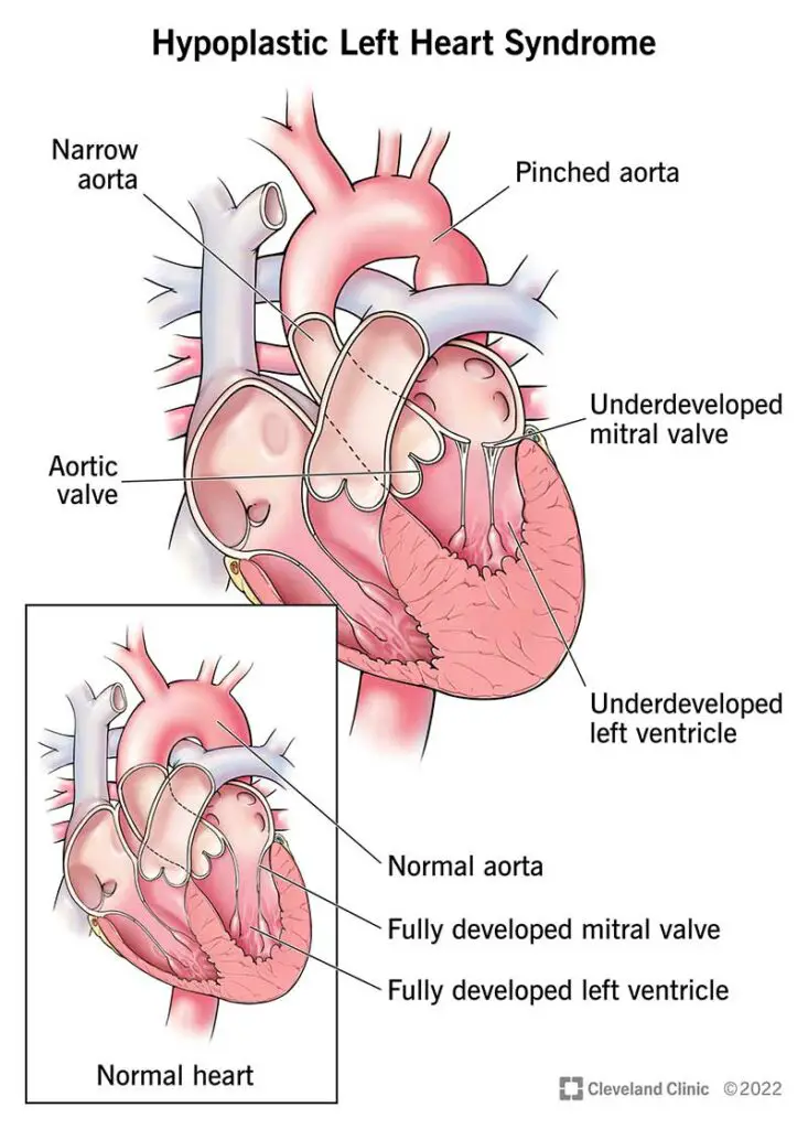 1705246281 12214 hypoplastic left heart syndrome