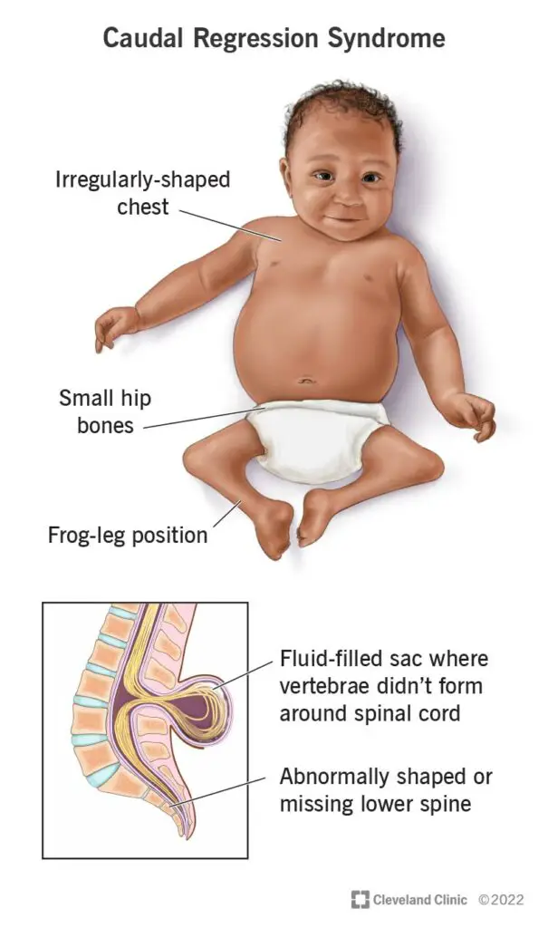 1705296199 23425 caudal regression syndrome