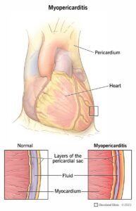 1705319243 24579 myopericarditis