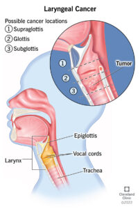 1705357638 16611 laryngeal cancer