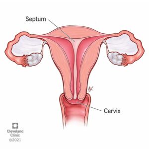 1705380676 22809 septate uterus