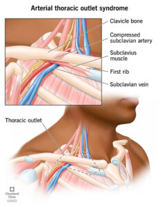 1705430781 23004 arterial thoracic outlet syndrome