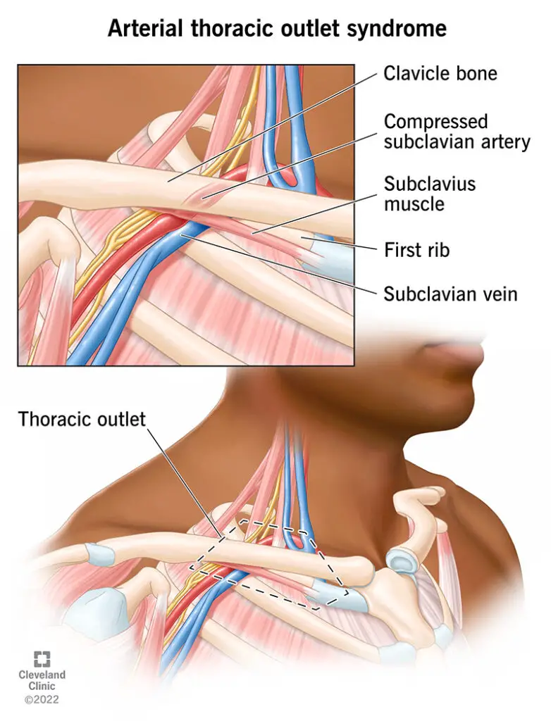 1705430781 23004 arterial thoracic outlet syndrome