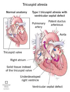 1705461737 14789 tricuspid atresia