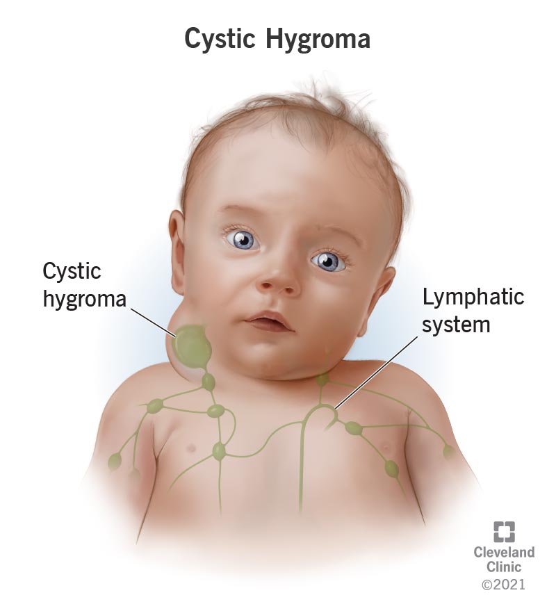 1705515561 22492 cystic hygroma