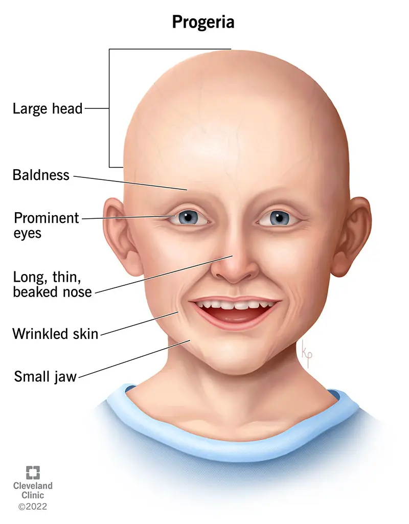 1705538657 17850 progeria