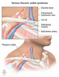 1705577602 22317 venous thoracic outlet syndrome