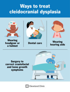 1705581442 24090 cleidocranial dysplasia