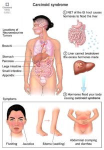 1705585284 22103 carcinoid syndrome