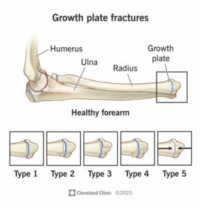 1705596860 growth plate fractures