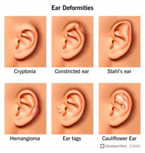 1705631538 24904 ear deformities