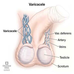 1705639218 15239 varicocele