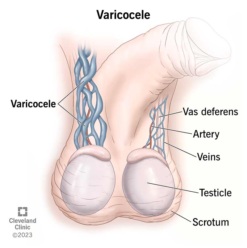 1705639218 15239 varicocele