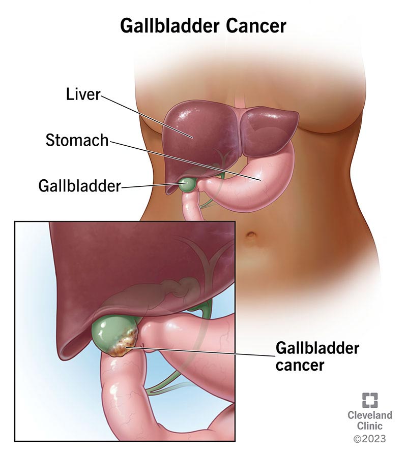 1705650803 17013 gallbladder cancer
