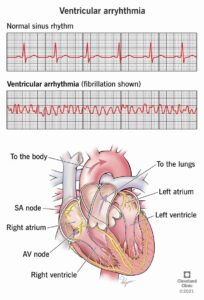 1705677866 21854 ventricular arrhythmia illustration