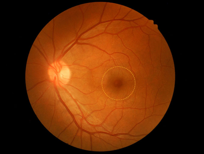 1705681704 14208 macular hole