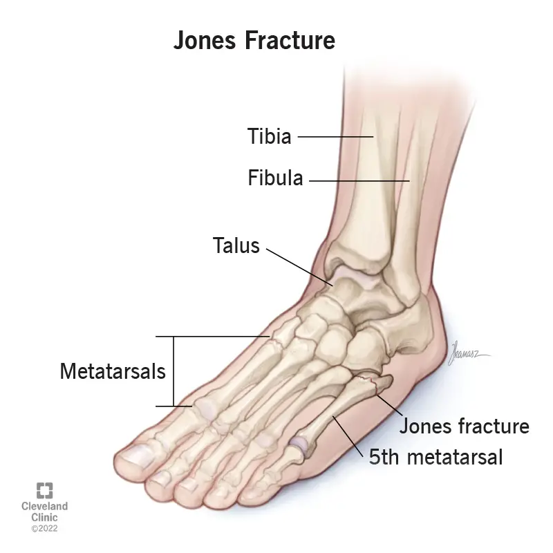 1705739661 22239 jones fracture