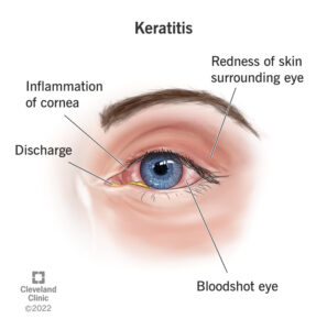 1705774583 24500 keratitis