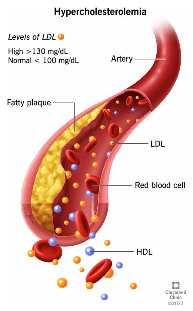 1705947687 23921 hypercholesterolemia