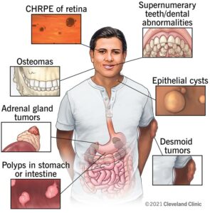 1706009362 22013 gardner syndrome