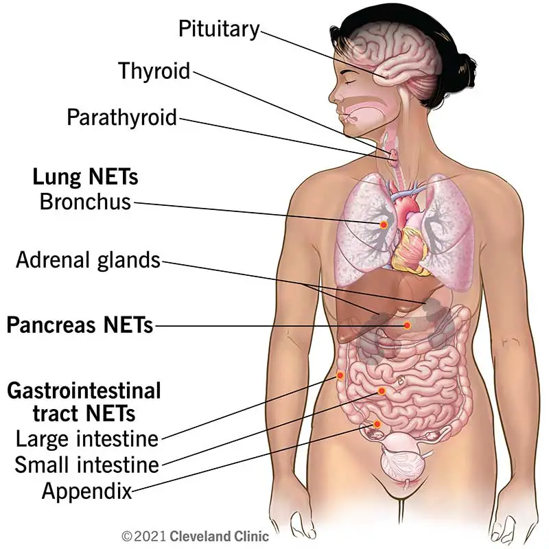 1706024789 22006 Neuroendocrine tumors