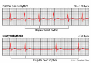 1706105845 23349 bradyarrhythmia