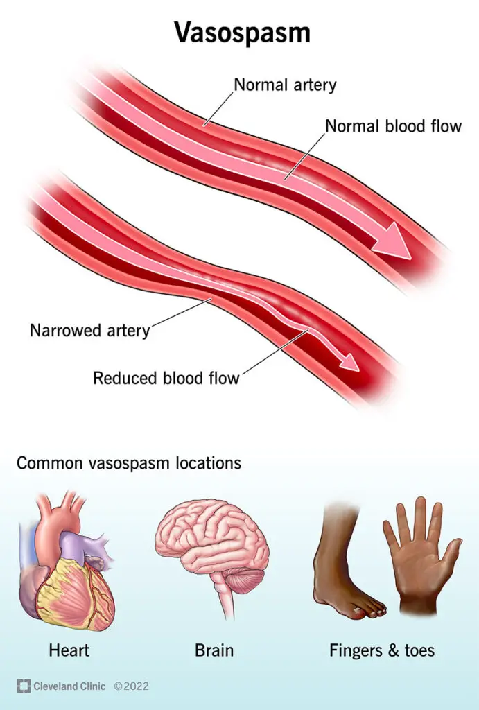 1706155940 24825 vasospasm illustration