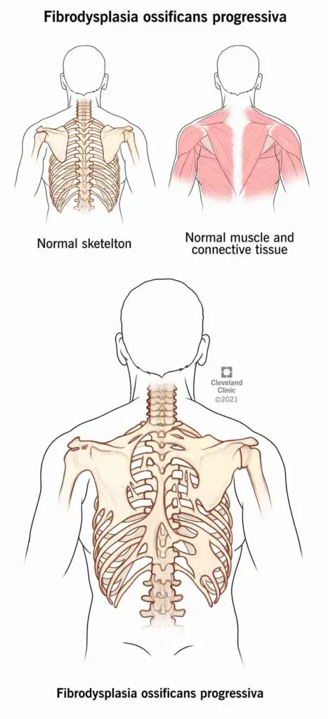 1706178984 24476 fibrodysplasia ossificans progressiva