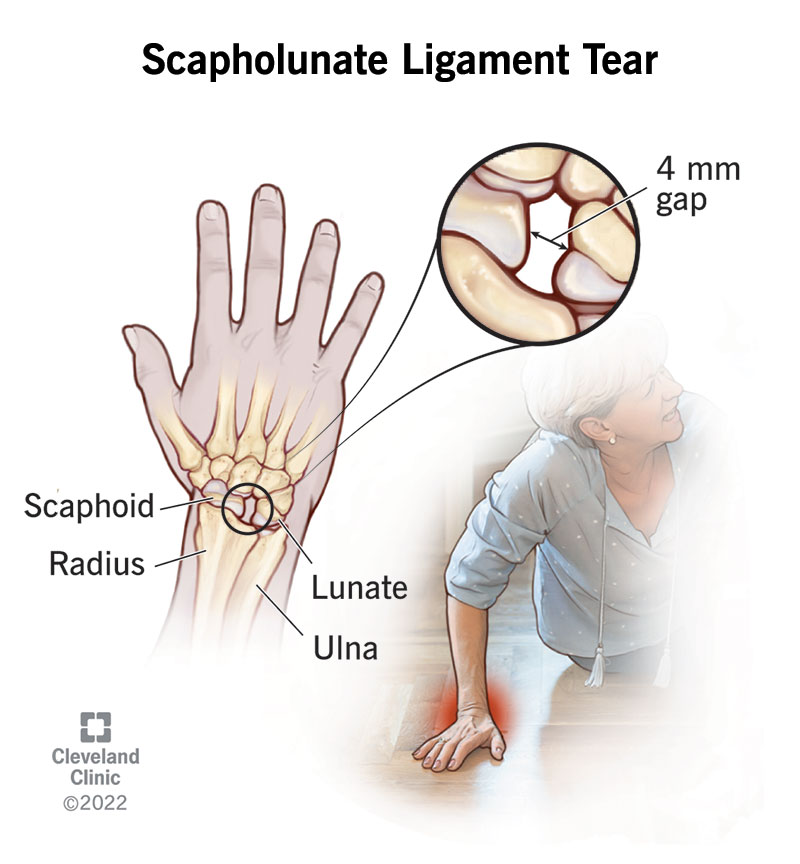 1706186667 24558 scapholunate ligament tear