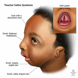 1706209701 22149 treacher collins syndrome