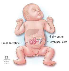 1706213540 22290 gastroschisis