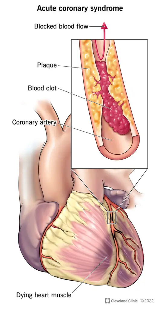 1706286744 22910 acute coronary syndrome