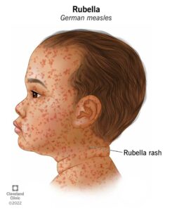 1706294425 17798 rubella