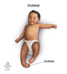 1706425460 16889 clubfoot