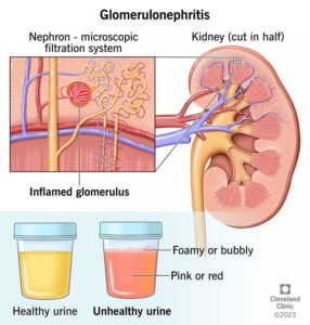 1706452399 16167 glomerulonephritis