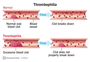 1706471660 21797 thrombophilia illustration