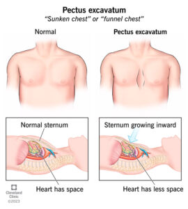 1706483175 17328 pectus excavatum