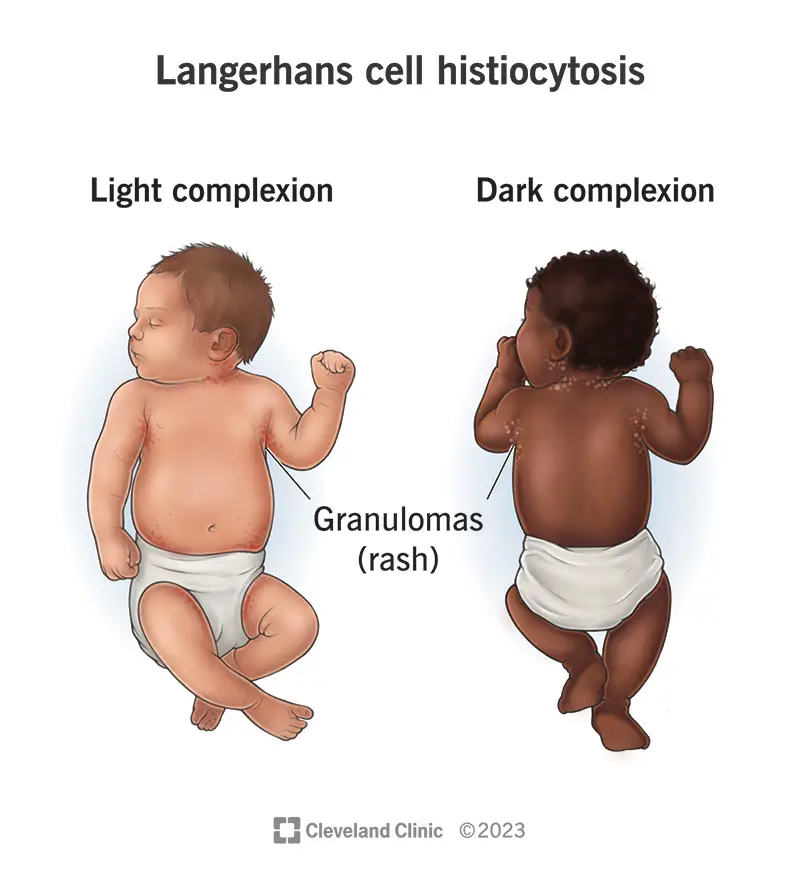 1706498544 langerhans cel histiocytosis