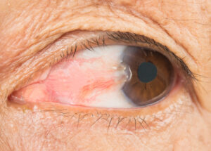 1706513900 22497 pterygium