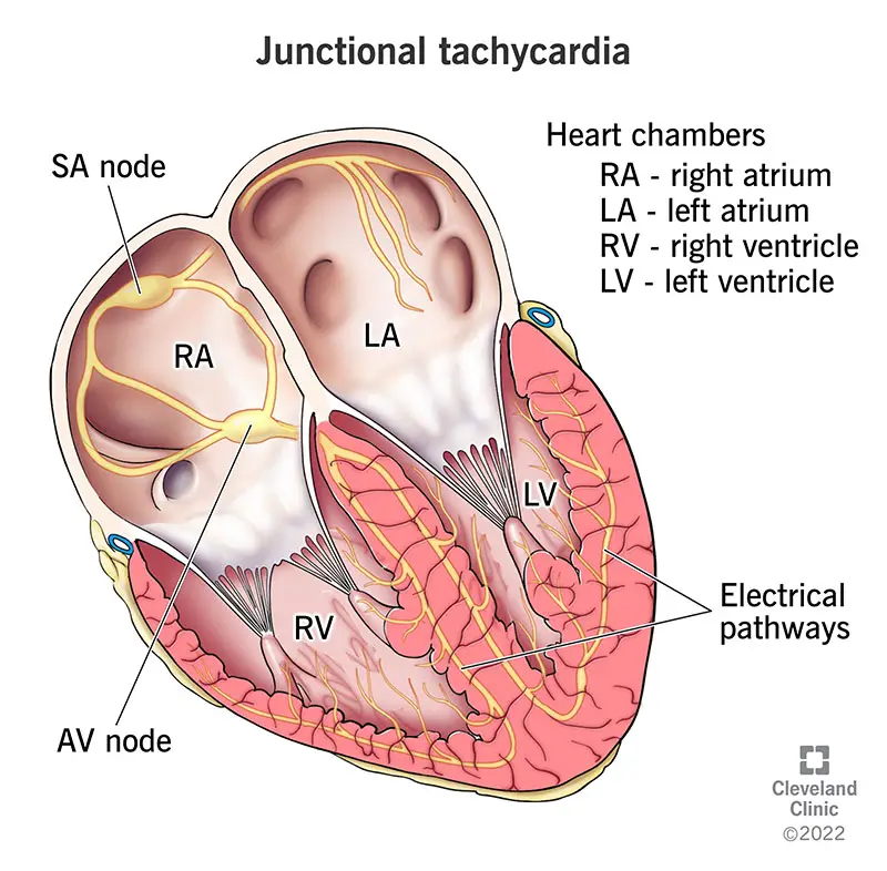 1706521590 23216 junctional tachycardia