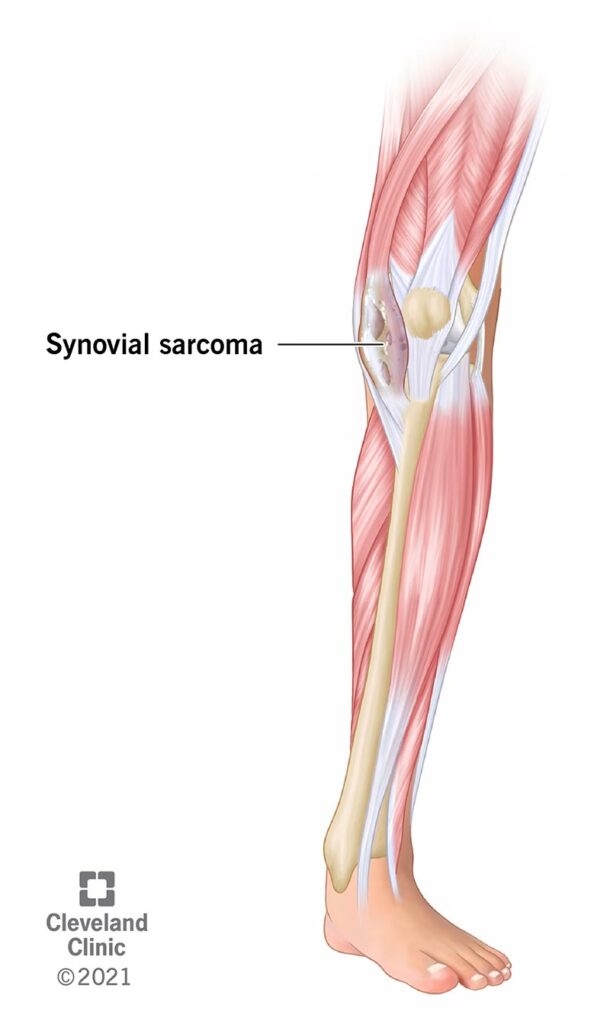 1706633664 22012 synovial sarcoma