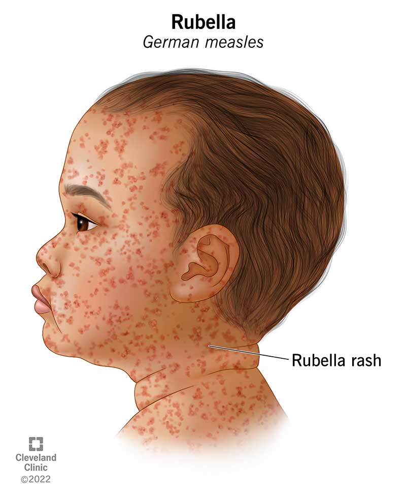 Illustratsioon punetiste lööbest lapsel, millel on kujutatud väikeste punaste täppide kogumit lapse näol ja kaelal.