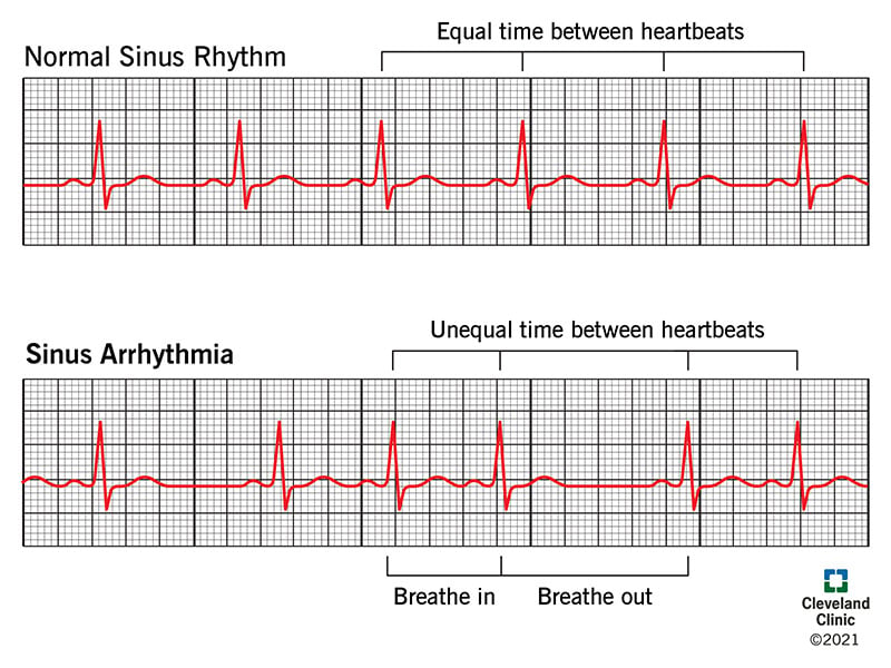 21666 sinus arrhythmia illustration