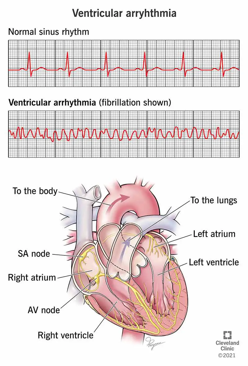 EKG, mis näitab ventrikulaarset arütmiat.