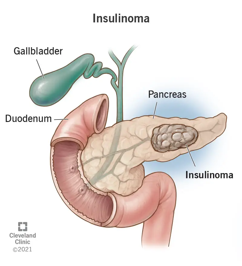 22217 insulinoma