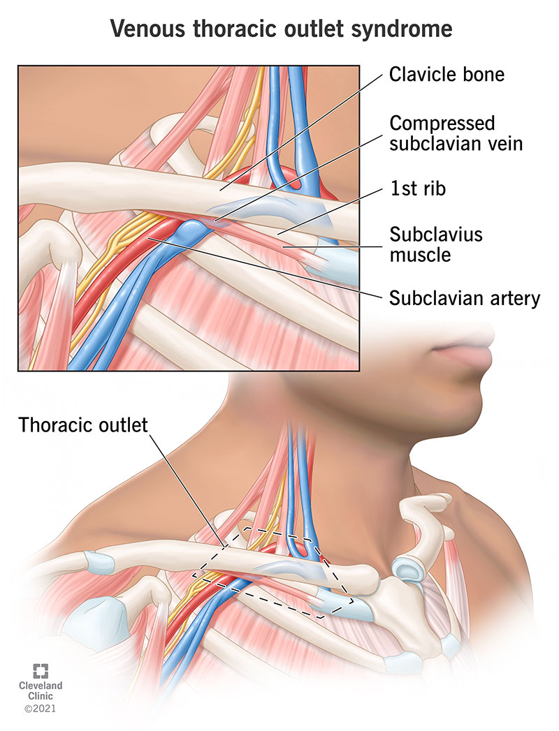 Veenide ja arterite kokkusurumine kraeluu ja esimese ribi vahel, mis põhjustab venoosse rindkere väljavoolu sündroomi.